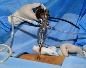Chirurgische Behandlung der lumbalen Osteochondose