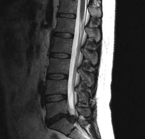 Diagnoseoptionen für die lumbale Osteochondose