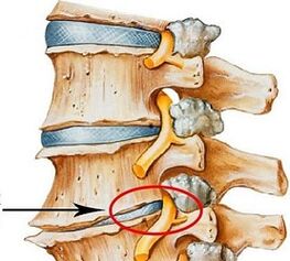 Weil es lumbale Osteochondose ist