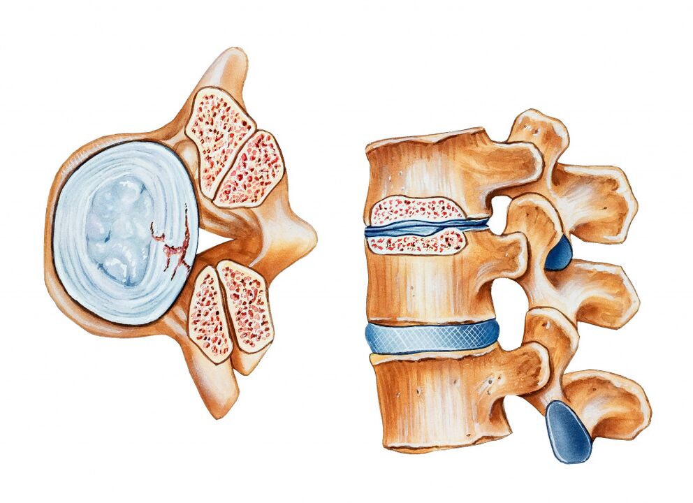 Die Osteochondrose der Gebärmutterhalsregion führt zur Zerstörung der Grandlebralaufzeichnungen