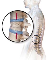 Osteoporose verursacht Rückenschmerzen im unteren Rücken des Rückens